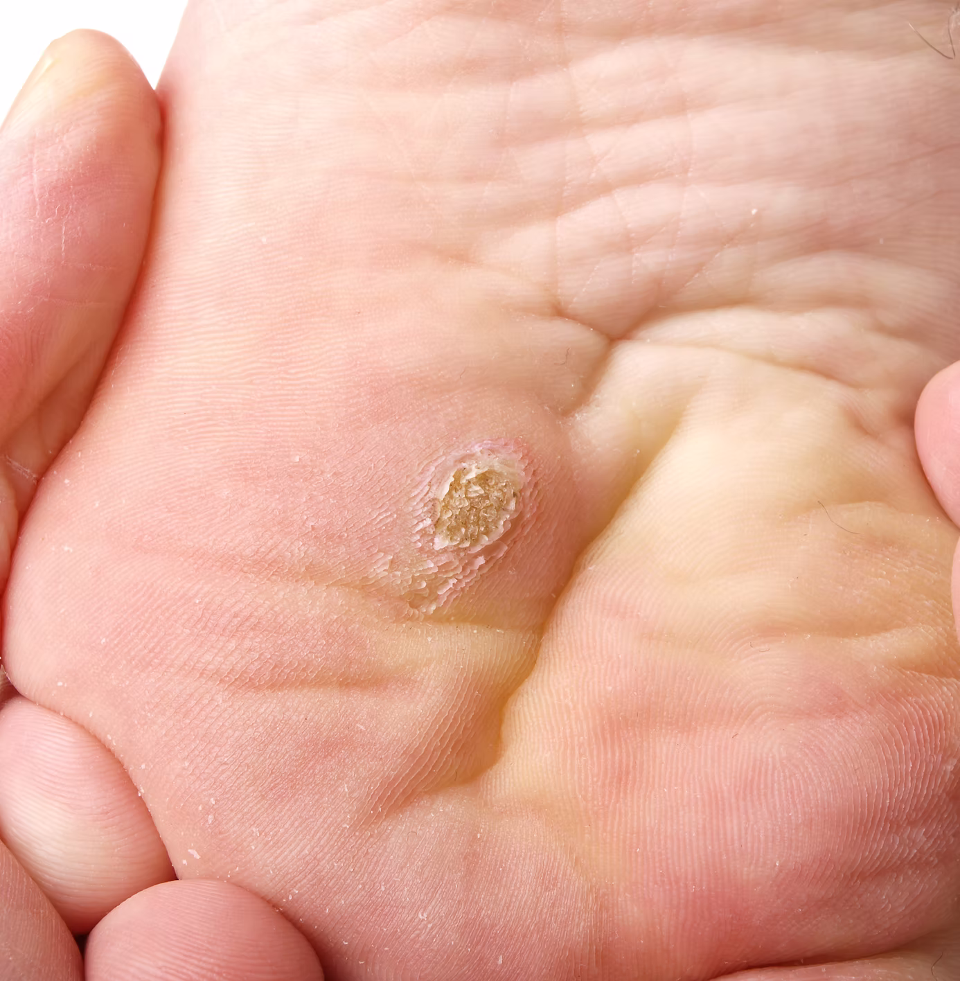 Close-up of a verruca on the sole of a foot